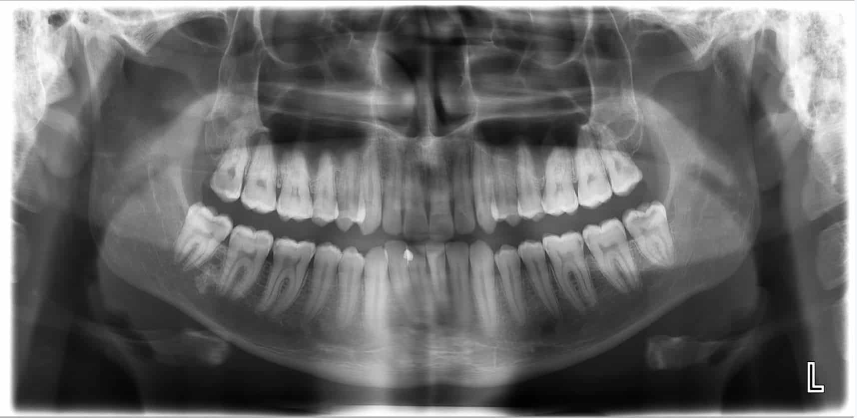 Wisdom Teeth X-Ray