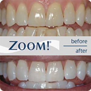ZOOM Teeth Whitening Chandler AZ