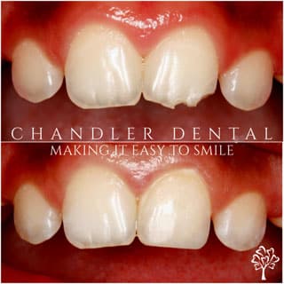 Cosmetic Dental Bonding Chandler - Before and After