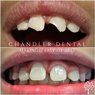 Cosmetic Dental Bonding Chandler - Before and After