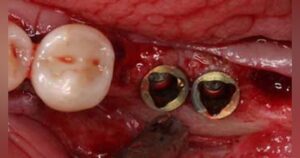 dental implants chandler az