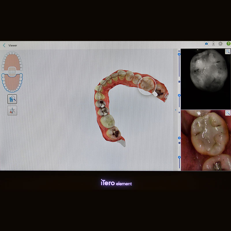 Chander Dental Digital Cavity Detection with Itero