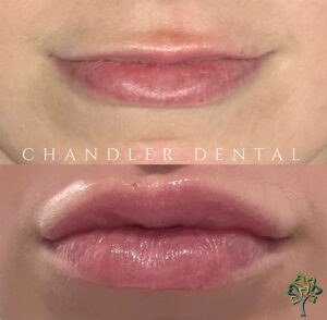 Chandler Dental Lip Fillers