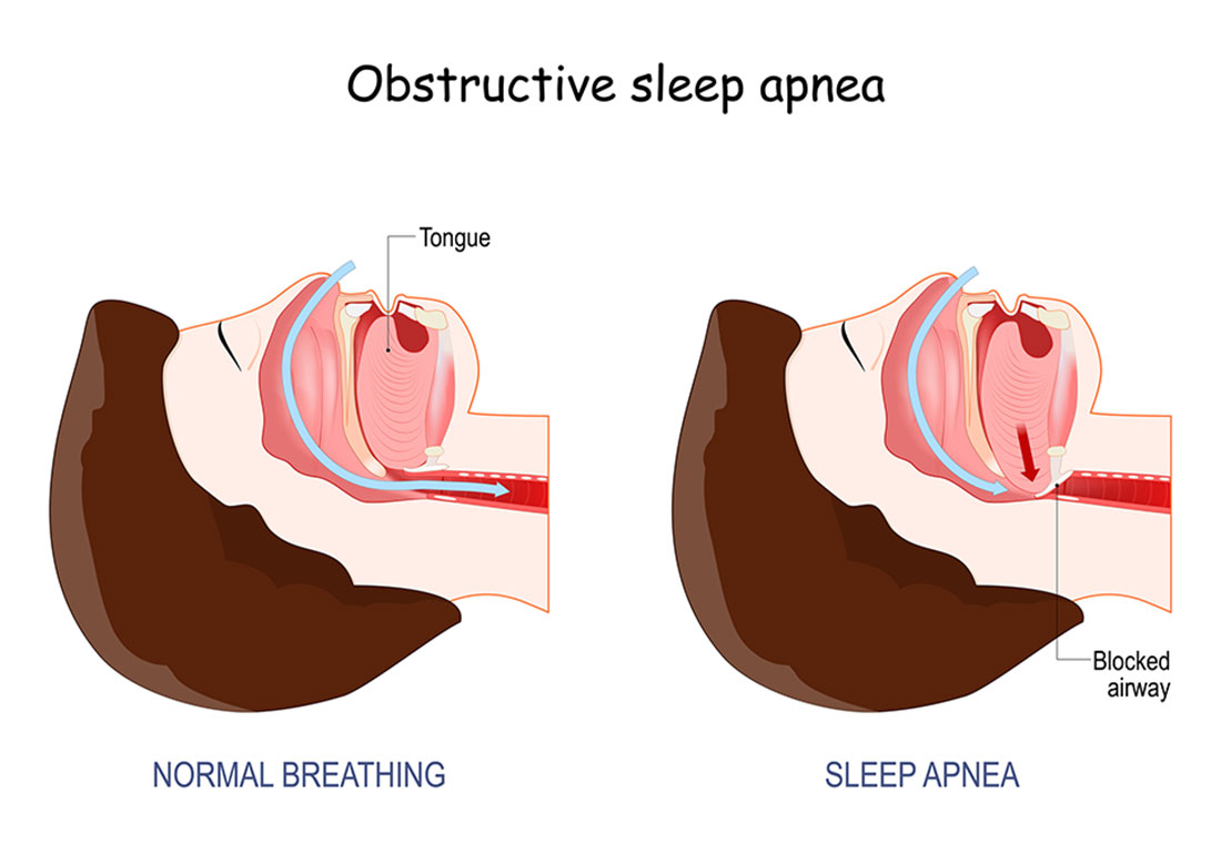 Sleep Apnea Obstructed Airway